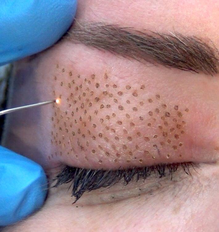 Aplicación plasma pen