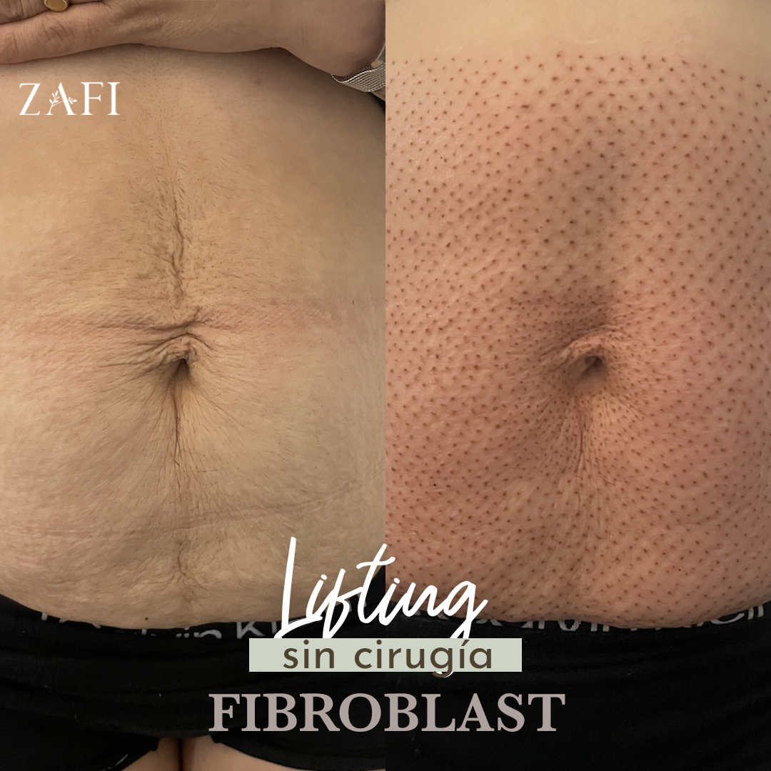 Fibroblast antes y después